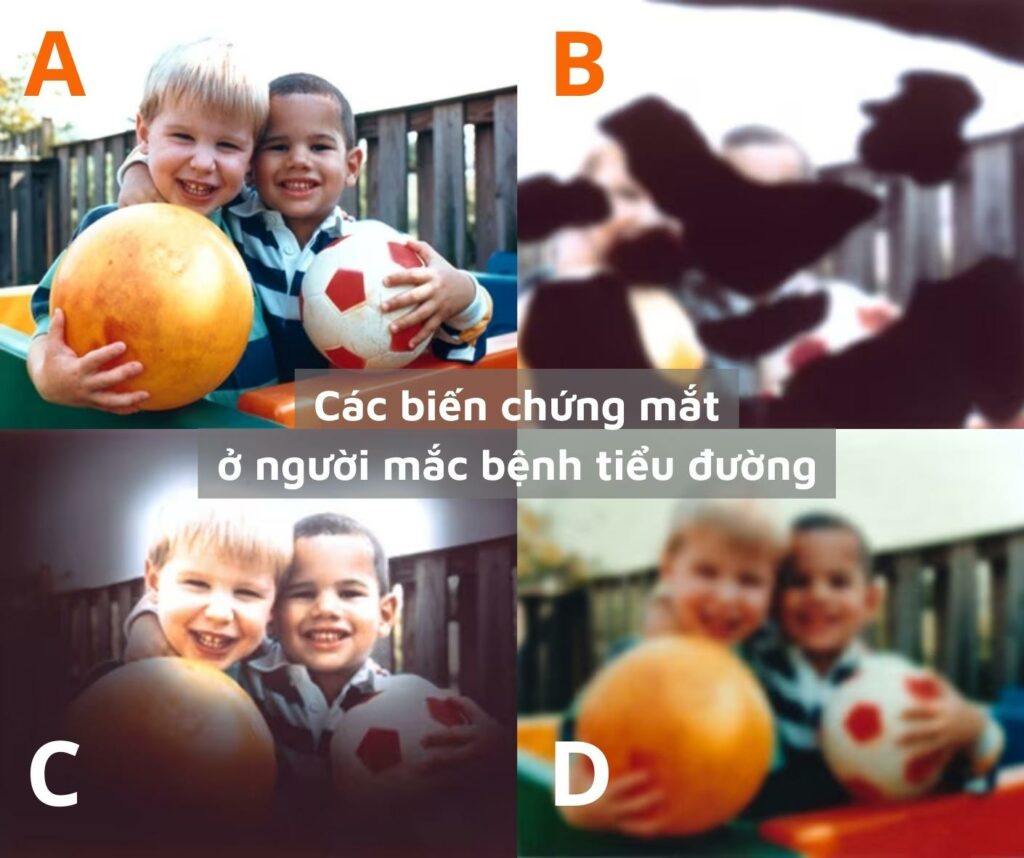 Các biến chứng mắt ở người mắc bệnh tiểu đường