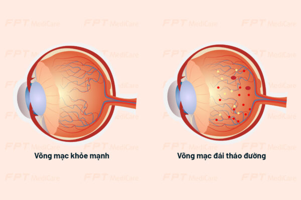 bệnh võng mạc tiểu đường 