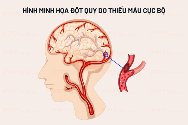 đột quỵ do thiếu máu cục bộ