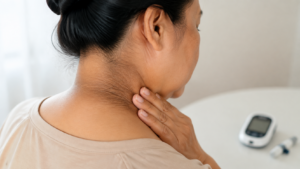 gai đen do biến chứng bệnh tiểu đường